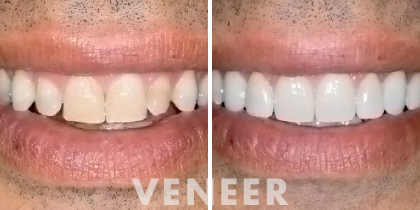 veneers - justice dental