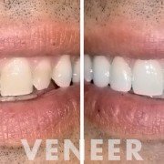 veneers - justice dental