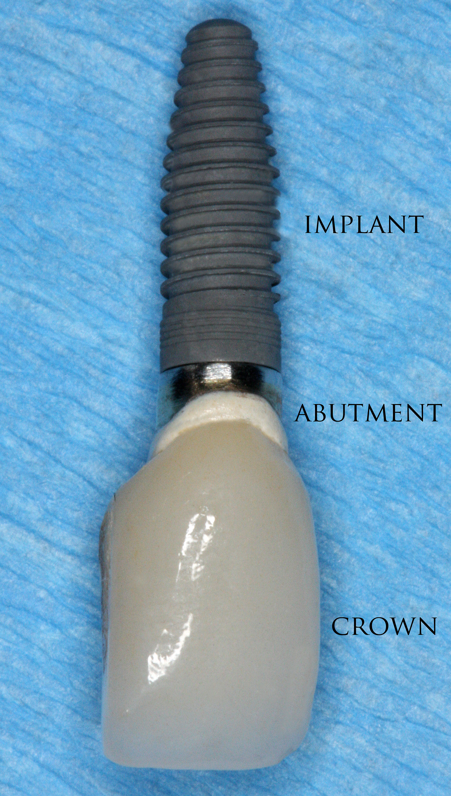 justice dental implant