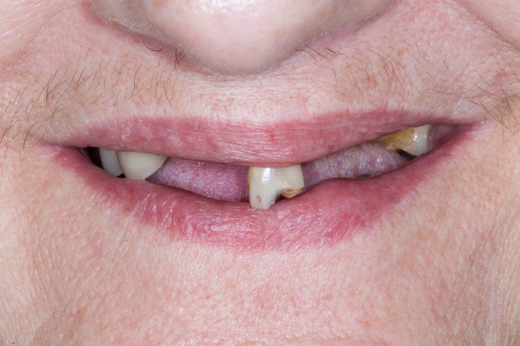 Ill-Fitting Denture - Before