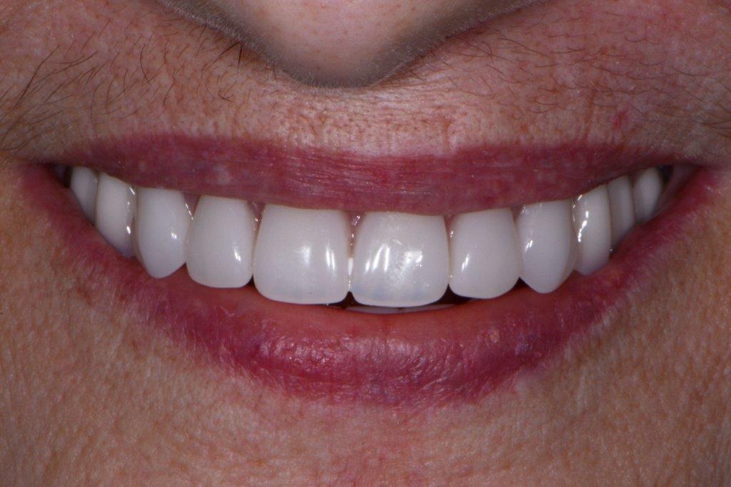 Ill Fitting Denture - After