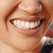 teeth whitening service