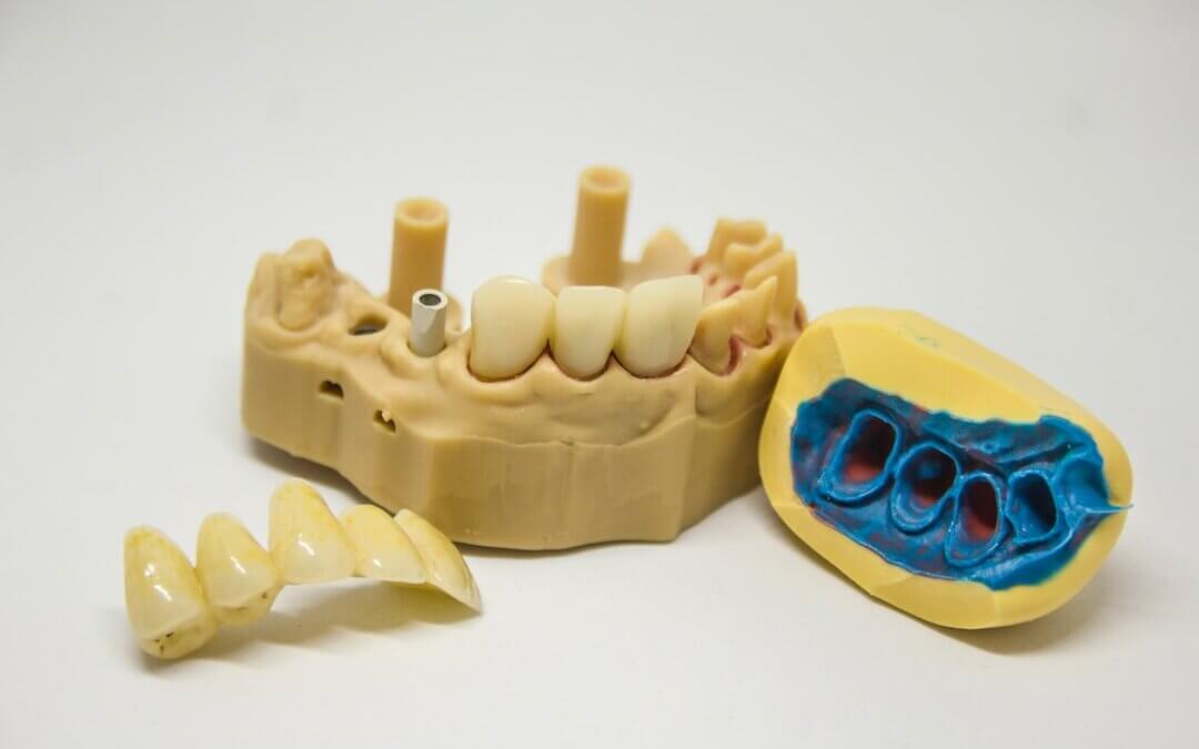 bone grafting for dental implants
